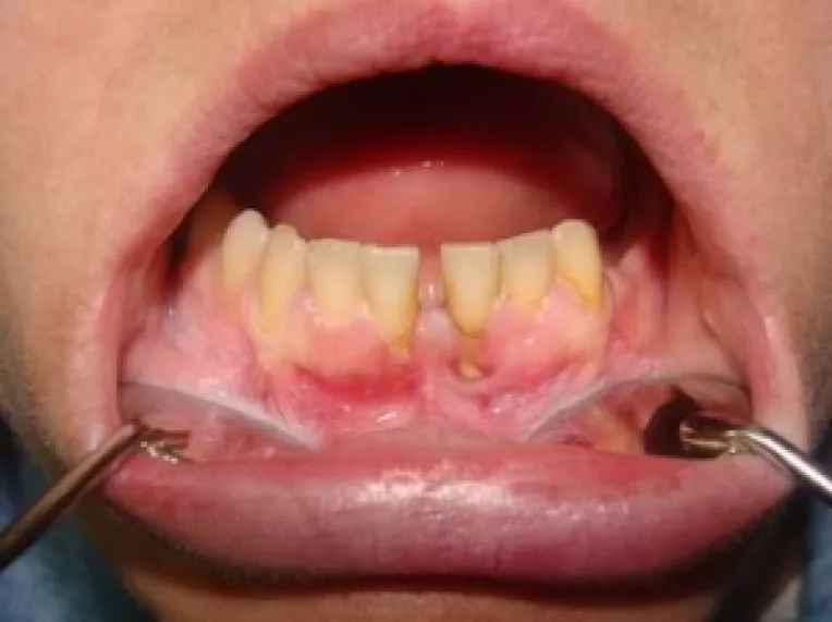Retractia gingivala poate fi provocata si de afectiuni parodontale